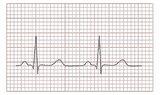 ECG